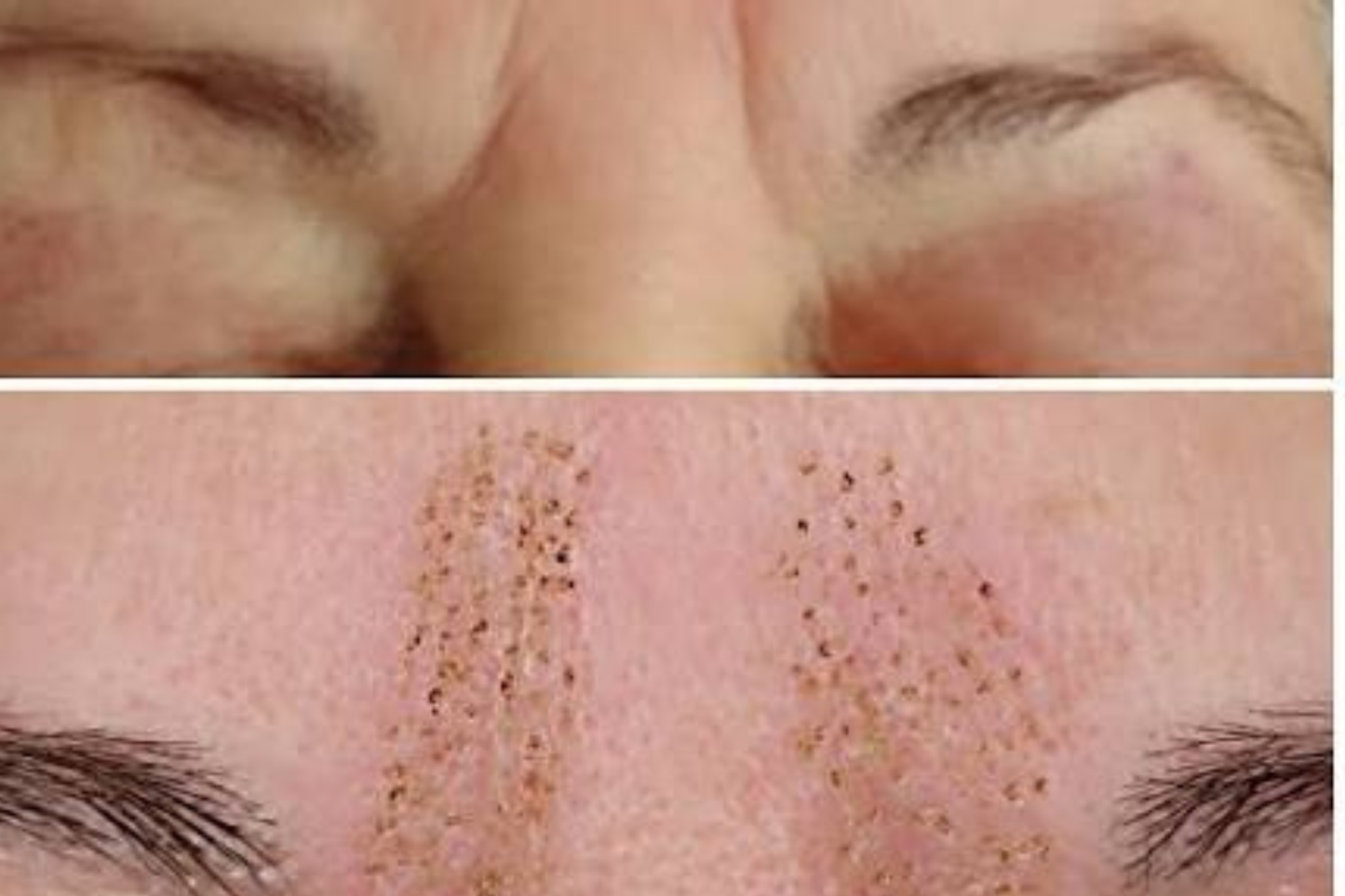 Plasma Pen Fibroblast Frown Line