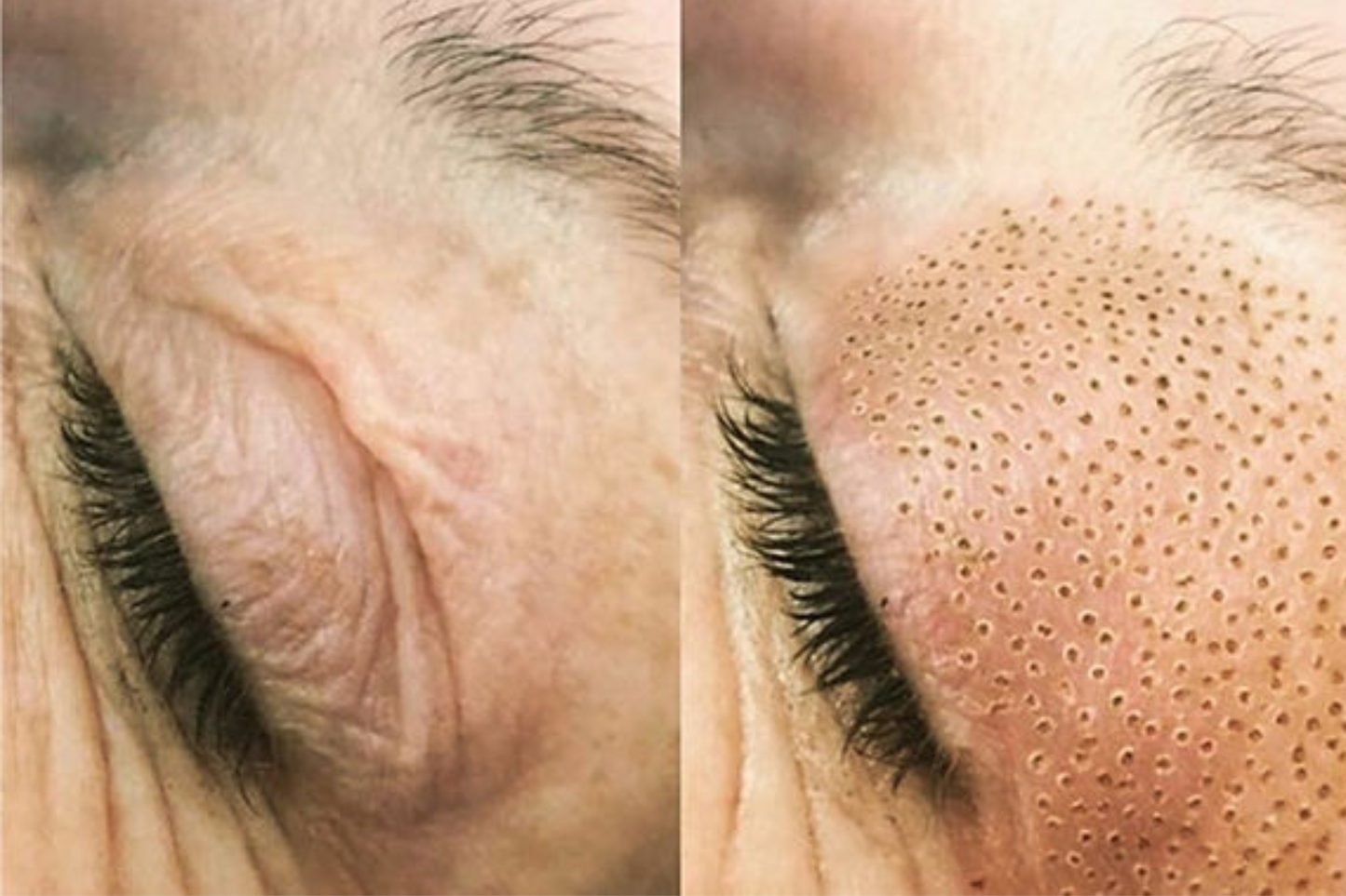 Plasma Pen Fibroblast Upper Eyelid