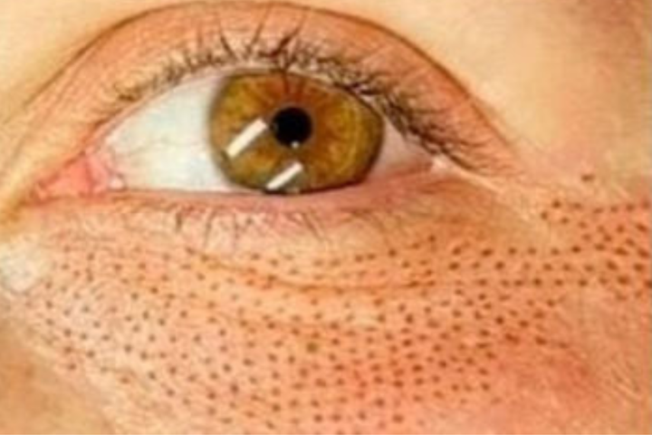 Plasma Pen Fibroblast Lower Eyelid 