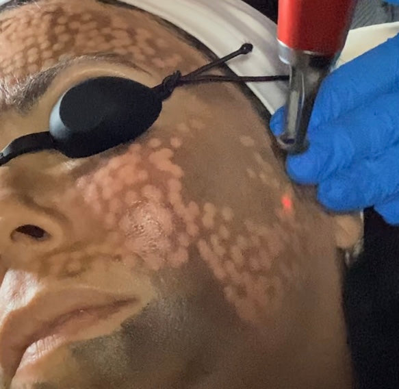 Hollywood Laser Peel