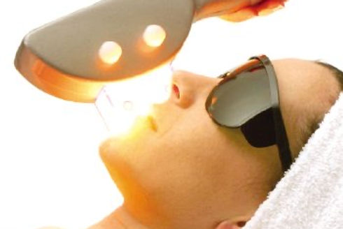 12 Sessions Diode Laser Hair Removal on Chin