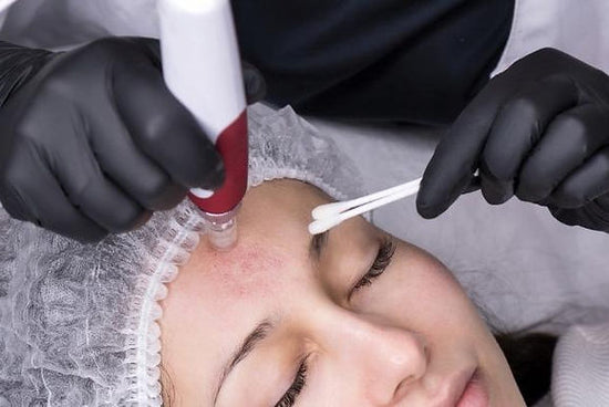 12 Sessions of Facial Microneedling