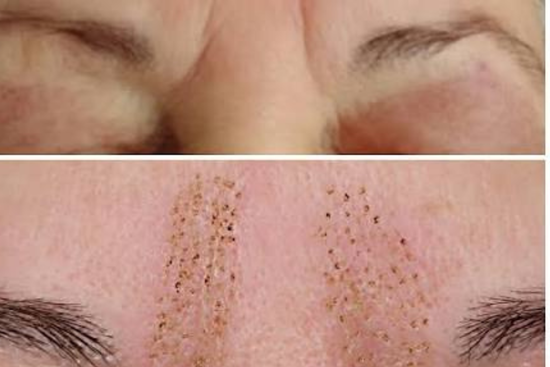 Plasma Pen Fibroblast Línea Entrecejo