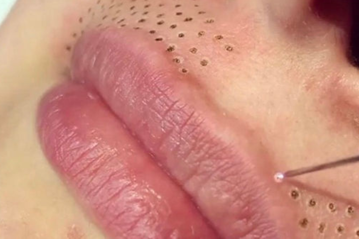 Plasma Pen Fibroblast Mustache