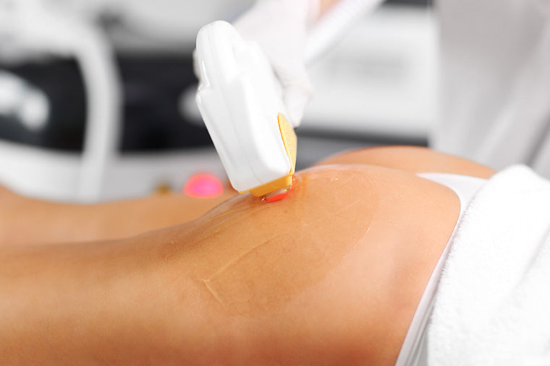 Laser hair removal on buttocks with diode laser