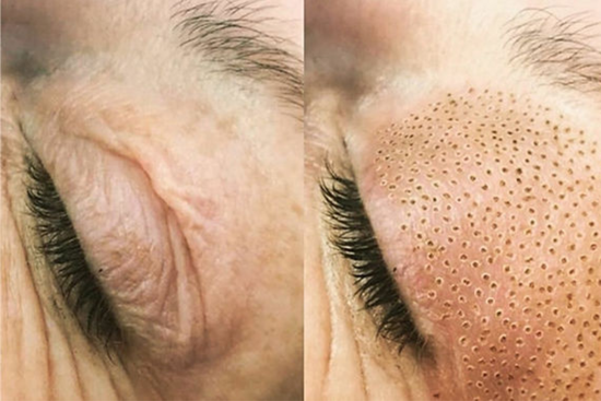 Plasma Pen Fibroblast Upper Eyelid 