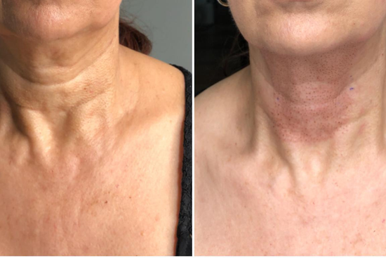 Plasma Pen Fibroblast Papada