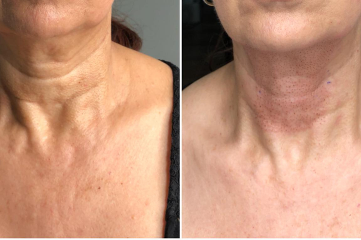 Plasma Pen Fibroblast Double Chin 