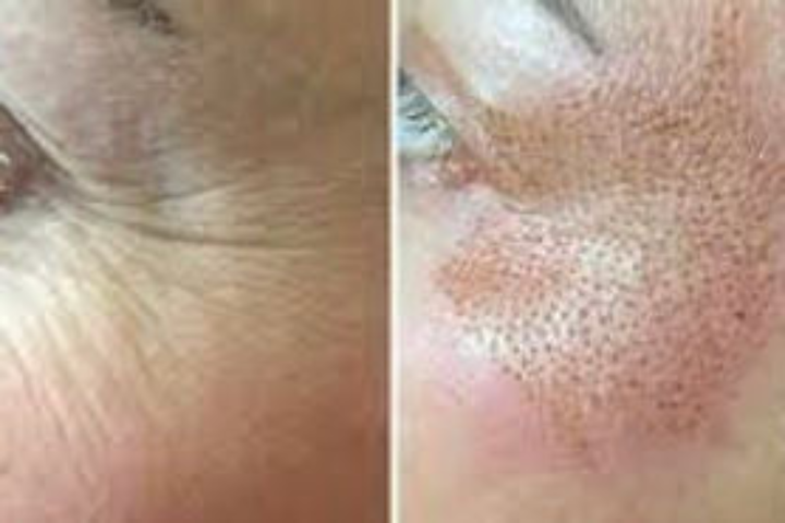 Plasma Pen Fibroblast Crow's Feet