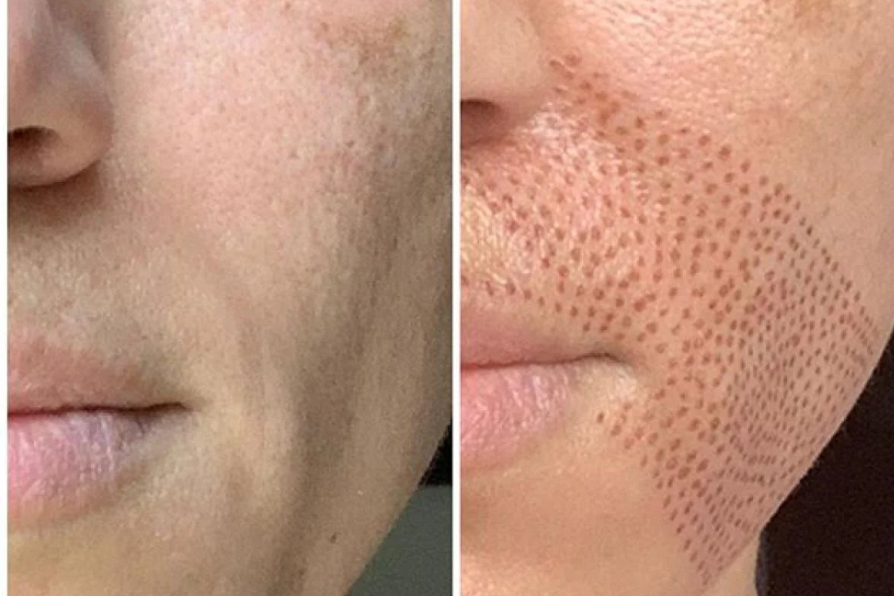 Plasma Pen Fibroblast Nasolabial Furrow