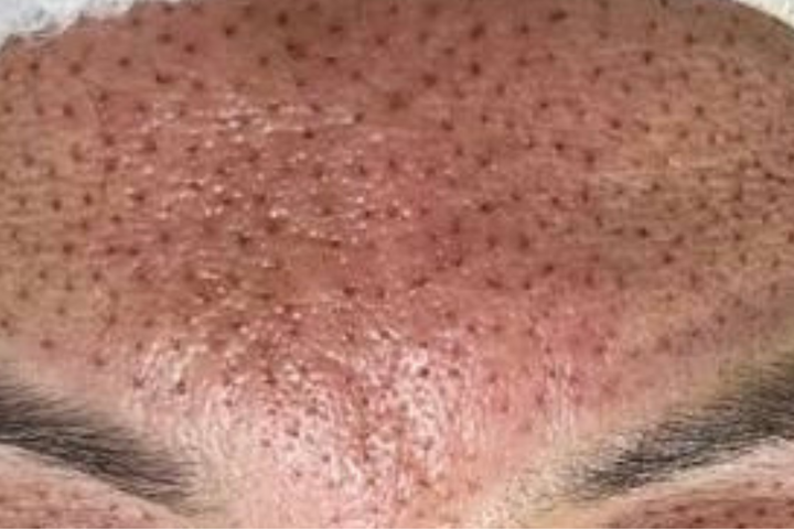 Plasma Pen Fibroblast Forehead 